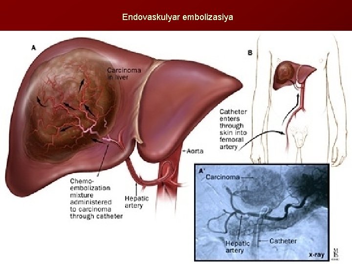 Endovaskulyar embolizasiya 