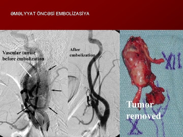 ƏMƏLYYAT ÖNCƏSİ EMBOLİZASİYA 