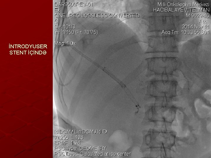 İNTRODYUSER STENT İÇİNDƏ 