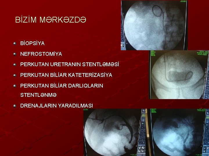BİZİM MƏRKƏZDƏ BİOPSİYA NEFROSTOMİYA PERKUTAN URETRANIN STENTLƏMƏSİ PERKUTAN BİLİAR KATETERİZASİYA PERKUTAN BİLİAR DARLIQLARIN STENTLƏNMƏ