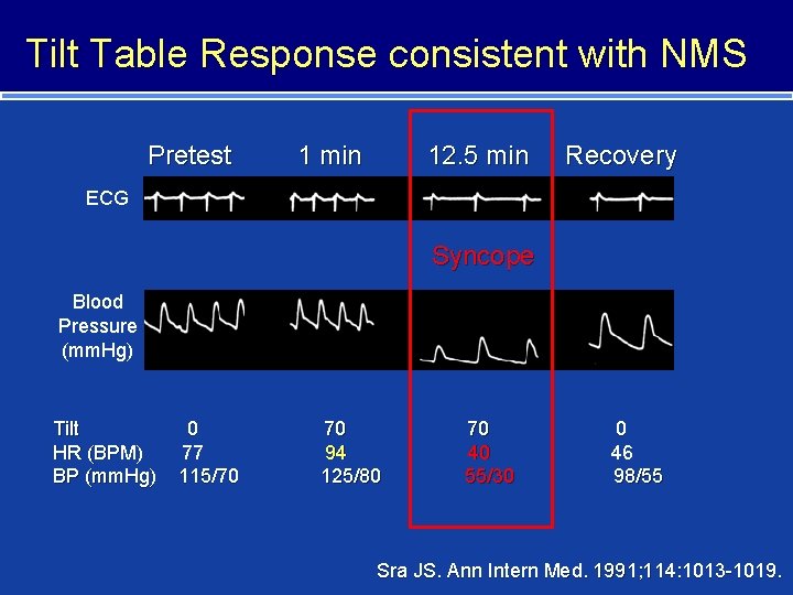 Tilt Table Response consistent with NMS Pretest 1 min 12. 5 min Recovery ECG