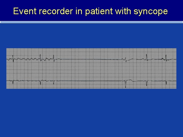 Event recorder in patient with syncope 