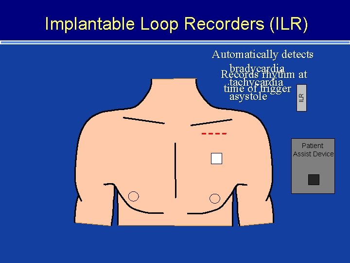 Implantable Loop Recorders (ILR) ILR Automatically detects bradycardia Records rhythm at tachycardia time of