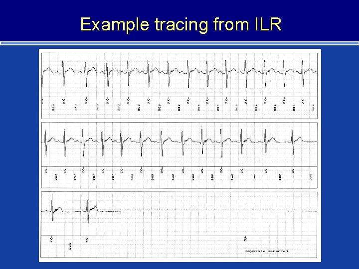 Example tracing from ILR 