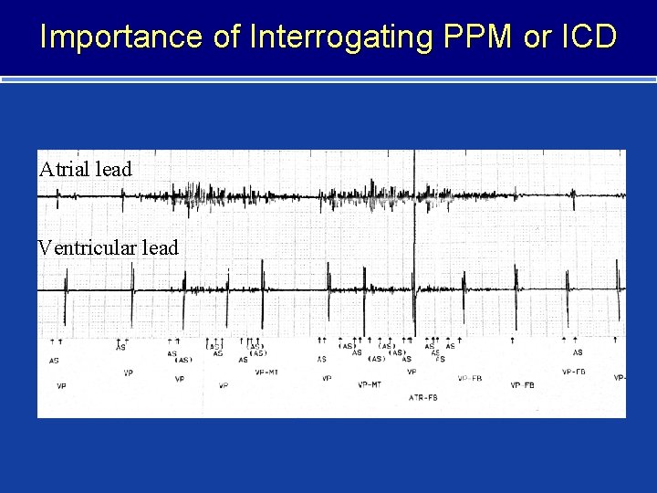Importance of Interrogating PPM or ICD Atrial lead Ventricular lead 