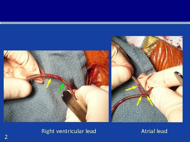 2 Right ventricular lead Atrial lead 
