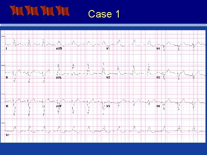 Case 1 Suspected or known structural heart disease - prior MI Abnormal EKG –