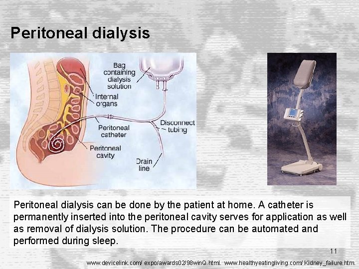 Peritoneal dialysis can be done by the patient at home. A catheter is permanently Peritoneal dialysis can be done by the patient at home. A catheter is permanently