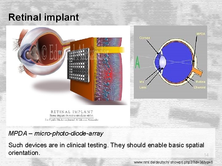 Retinal implant MPDA – micro-photo-diode-array Such devices are in clinical testing. They should enable Retinal implant MPDA – micro-photo-diode-array Such devices are in clinical testing. They should enable