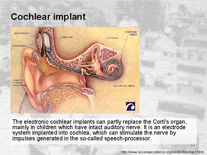 Cochlear implant The electronic cochlear implants can partly replace the Corti's organ, mainly in Cochlear implant The electronic cochlear implants can partly replace the Corti's organ, mainly in