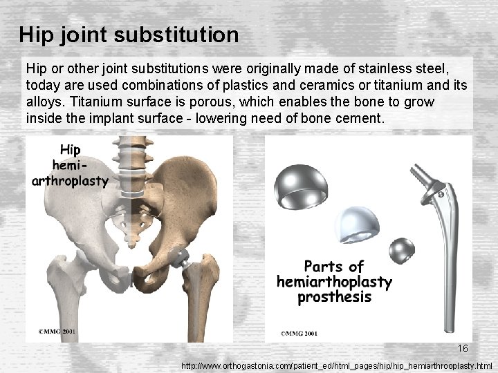 Hip joint substitution Hip or other joint substitutions were originally made of stainless steel, Hip joint substitution Hip or other joint substitutions were originally made of stainless steel,