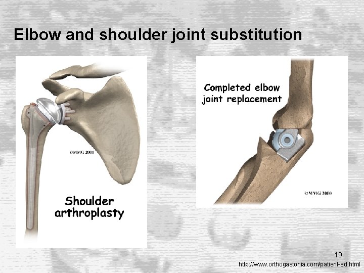 Elbow and shoulder joint substitution 19 http: //www. orthogastonia. com/patient-ed. html Elbow and shoulder joint substitution 19 http: //www. orthogastonia. com/patient-ed. html