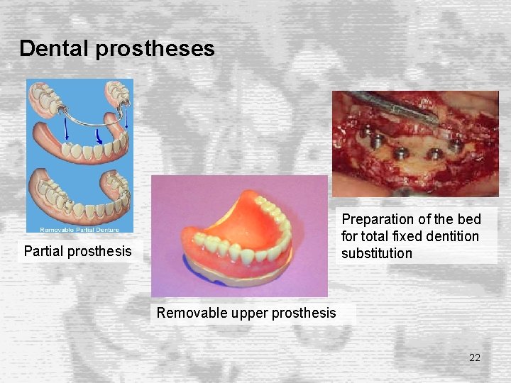 Dental prostheses Preparation of the bed for total fixed dentition substitution Partial prosthesis Removable Dental prostheses Preparation of the bed for total fixed dentition substitution Partial prosthesis Removable