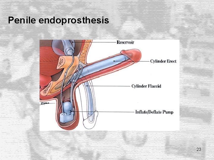 Penile endoprosthesis 23 Penile endoprosthesis 23