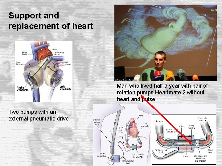 Support and replacement of heart Man who lived half a year with pair of Support and replacement of heart Man who lived half a year with pair of