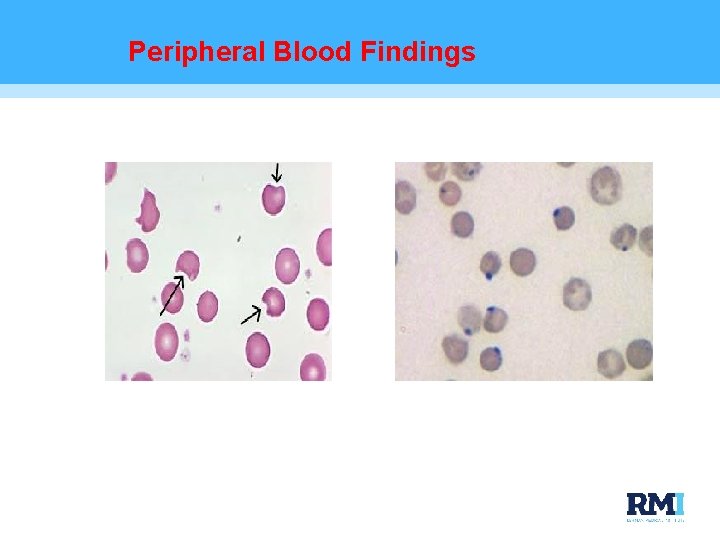 Peripheral Blood Findings 