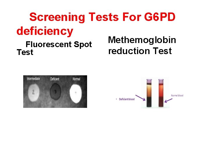 Screening Tests For G 6 PD deficiency Fluorescent Spot Test Methemoglobin reduction Test 