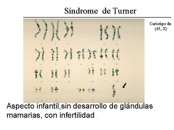 Síndrome de Turner Cariotipo de (45, X) Aspecto infantil, sin desarrollo de glándulas mamarias,