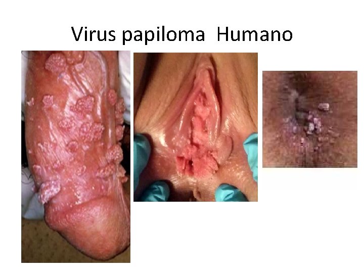 Virus papiloma Humano 