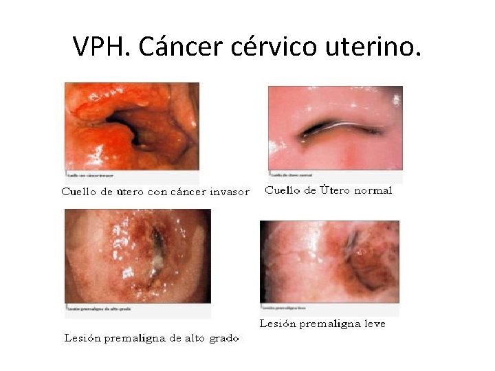 VPH. Cáncer cérvico uterino. 