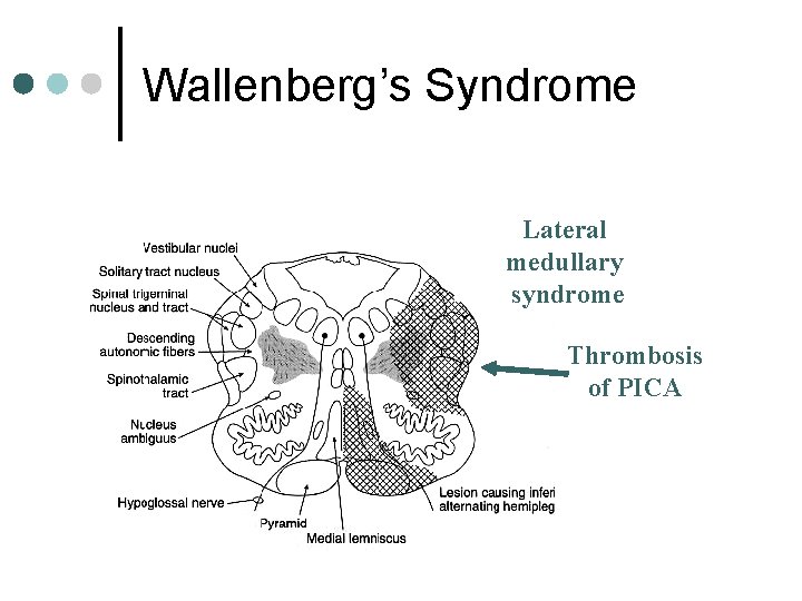 Wallenberg’s Syndrome Lateral medullary syndrome Thrombosis of PICA 