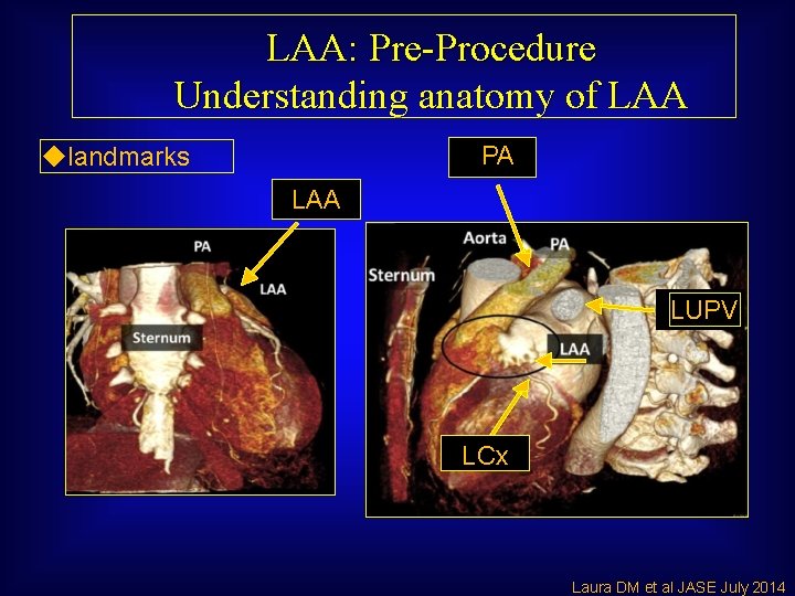 LAA: Pre-Procedure Understanding anatomy of LAA PA ◆landmarks LAA LUPV LCx Laura DM et