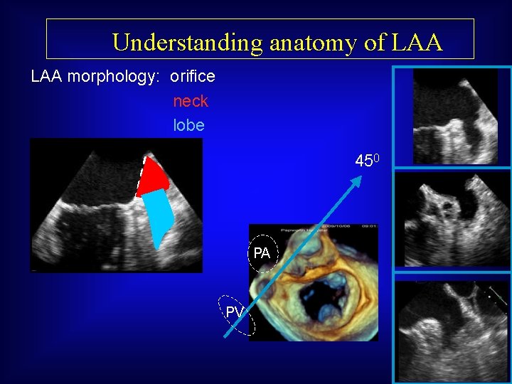 Understanding anatomy of LAA morphology: orifice neck lobe 450 PA PV 