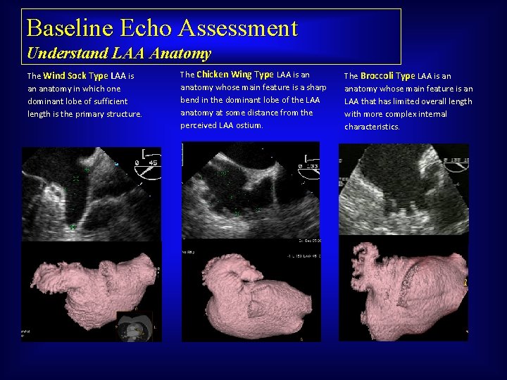 Baseline Echo Assessment Understand LAA Anatomy The Wind Sock Type LAA is an anatomy