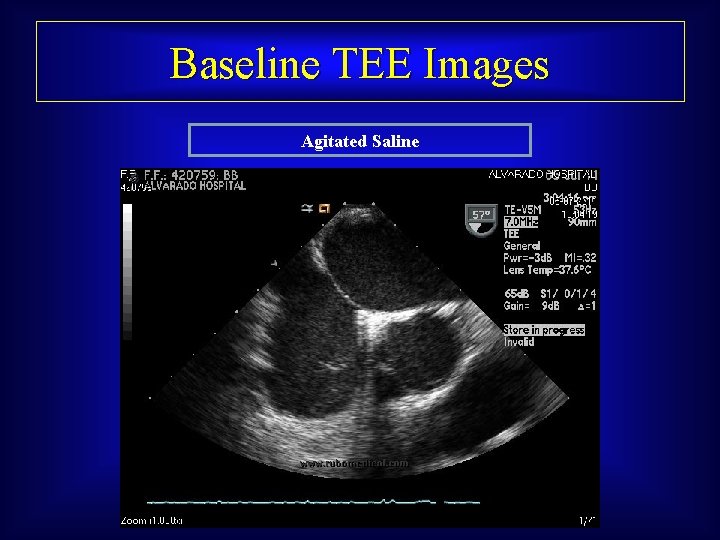 Baseline TEE Images Agitated Saline 