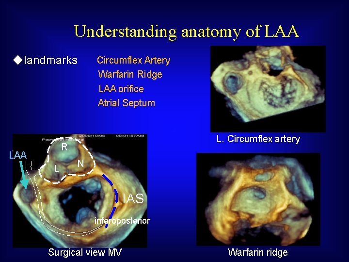 Understanding anatomy of LAA ◆landmarks Circumflex Artery Warfarin Ridge LAA orifice Atrial Septum L.