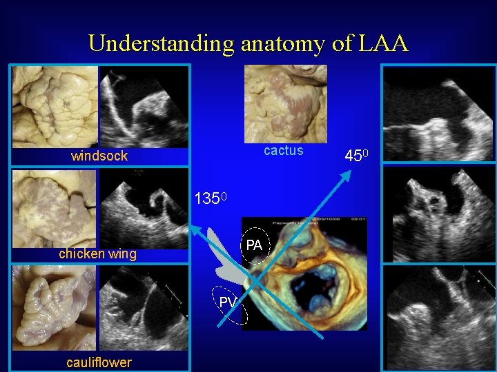 Understanding anatomy of LAA cactus windsock 1350 PA chicken wing PV cauliflower 450 