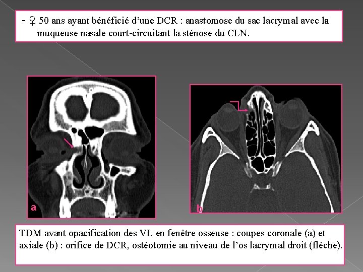 - ♀ 50 ans ayant bénéficié d’une DCR : anastomose du sac lacrymal avec