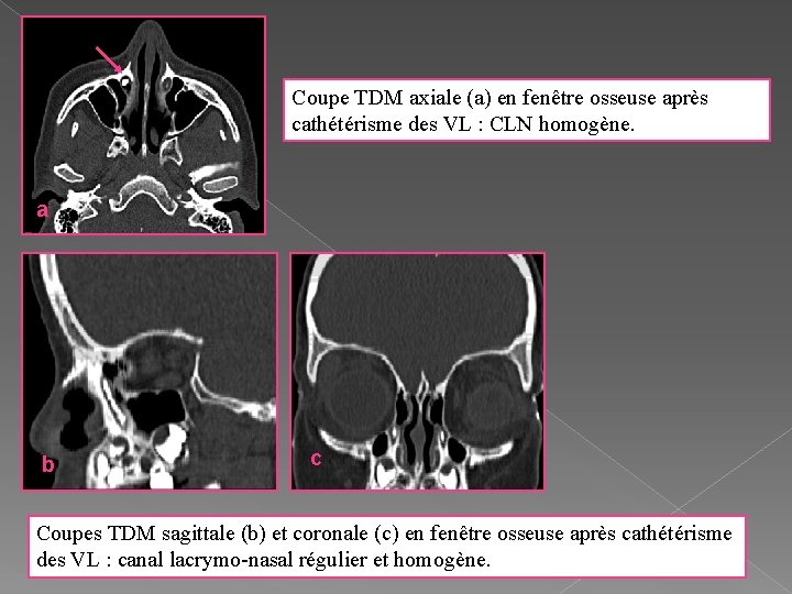 Coupe TDM axiale (a) en fenêtre osseuse après cathétérisme des VL : CLN homogène.