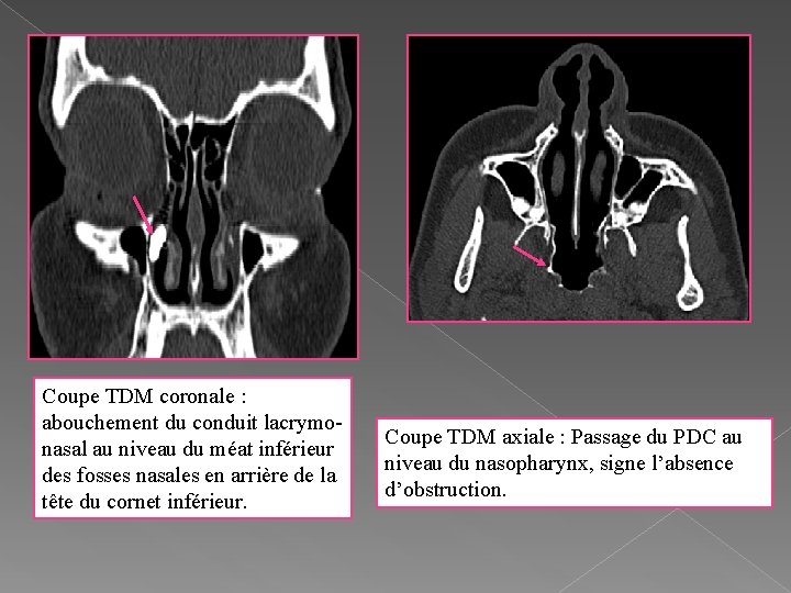 Coupe TDM coronale : abouchement du conduit lacrymonasal au niveau du méat inférieur des