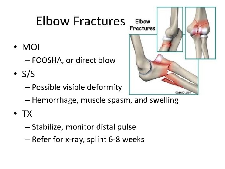 Elbow Fractures • MOI – FOOSHA, or direct blow • S/S – Possible visible