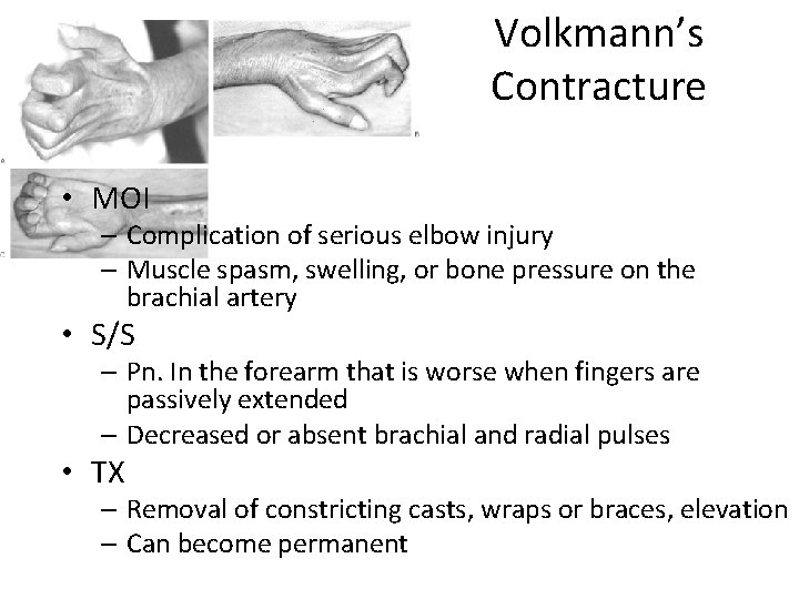 Volkmann’s Contracture • MOI – Complication of serious elbow injury – Muscle spasm, swelling,