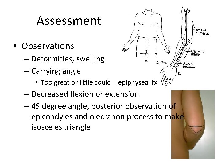 Assessment • Observations – Deformities, swelling – Carrying angle • Too great or little