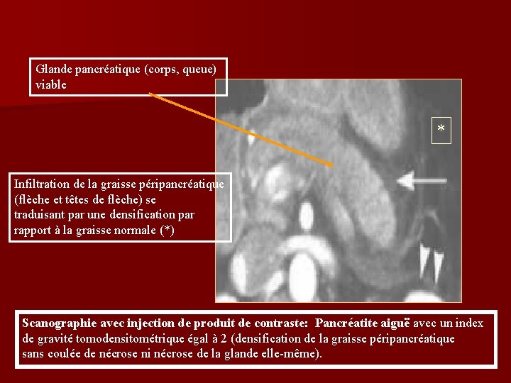 Glande pancréatique (corps, queue) viable * Infiltration de la graisse péripancréatique (flèche et têtes Glande pancréatique (corps, queue) viable * Infiltration de la graisse péripancréatique (flèche et têtes