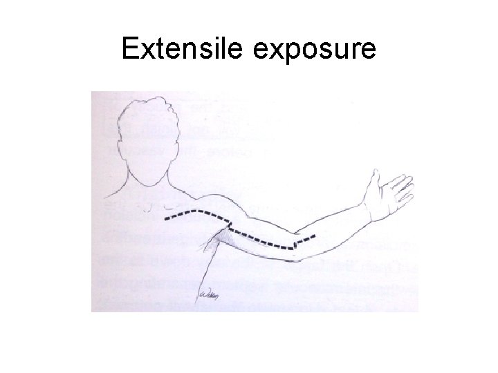 Extensile exposure 