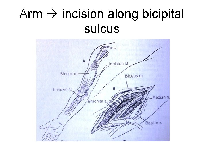 Arm incision along bicipital sulcus 