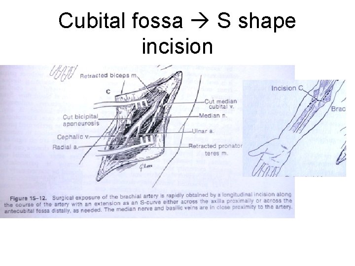 Cubital fossa S shape incision 
