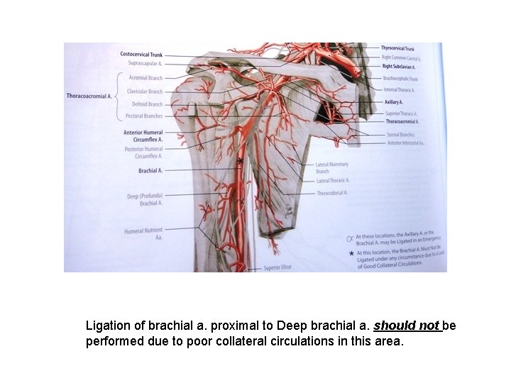 Ligation of brachial a. proximal to Deep brachial a. should not be performed due