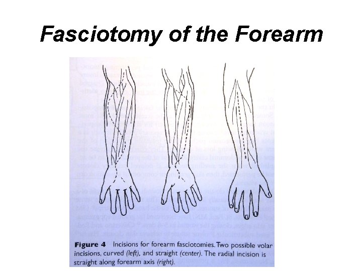 Fasciotomy of the Forearm 