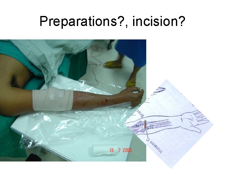 Preparations? , incision? 