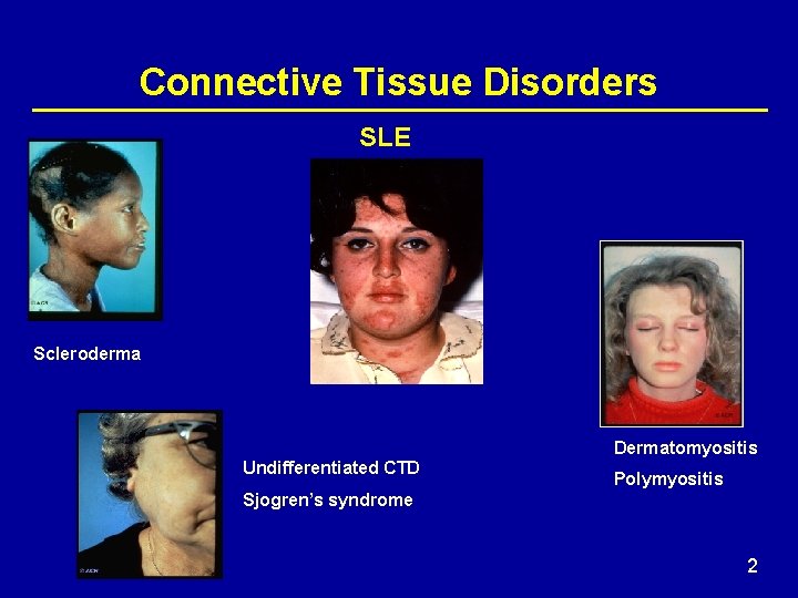 Connective Tissue Disorders SLE Scleroderma Dermatomyositis Undifferentiated CTD Polymyositis Sjogren’s syndrome 2 