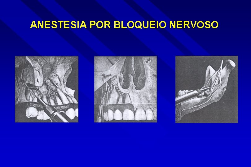 ANESTESIA POR BLOQUEIO NERVOSO 