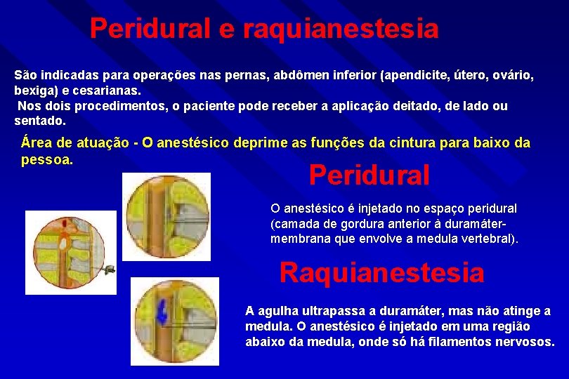 Peridural e raquianestesia São indicadas para operações nas pernas, abdômen inferior (apendicite, útero, ovário,