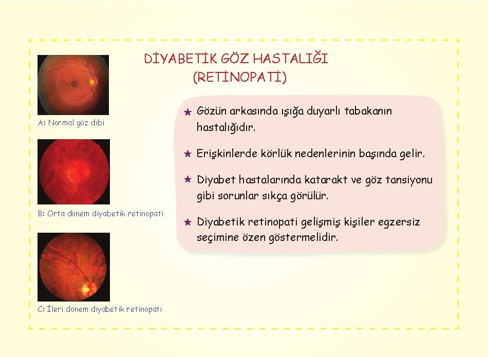 DİYABETİK GÖZ HASTALIĞI (RETİNOPATİ) A: Normal göz dibi Gözün arkasında ışığa duyarlı tabakanın hastalığıdır.