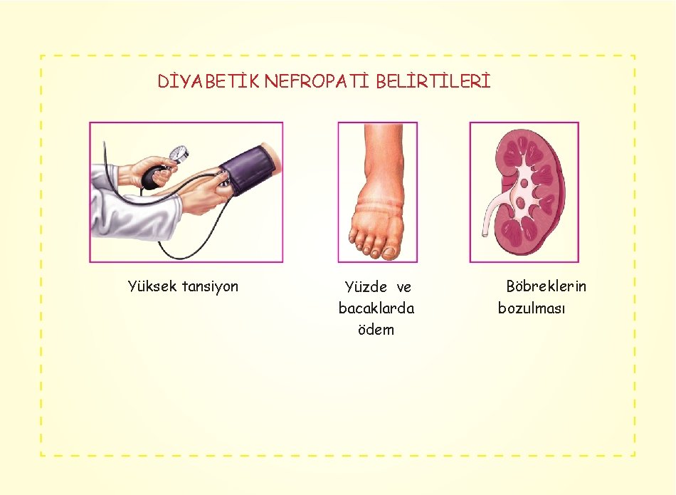 DİYABETİK NEFROPATİ BELİRTİLERİ Yüksek tansiyon Yüzde ve bacaklarda ödem Böbreklerin bozulması 