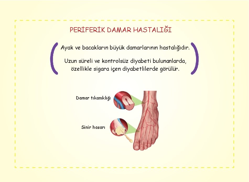 PERİFERİK DAMAR HASTALIĞI Ayak ve bacakların büyük damarlarının hastalığıdır. Uzun süreli ve kontrolsüz diyabeti